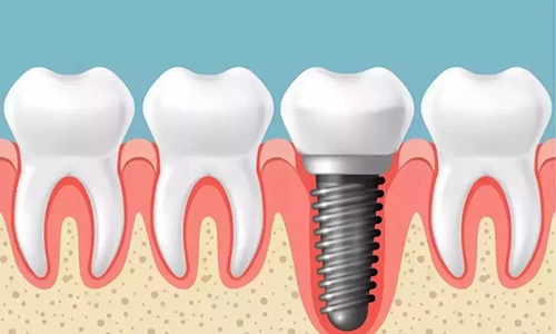 沈阳牙齿种植